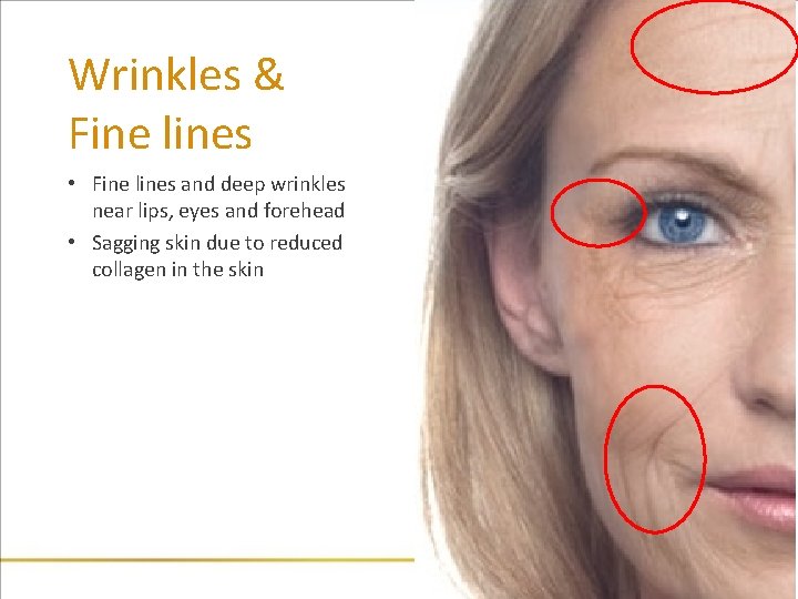 Wrinkles & Fine lines • Fine lines and deep wrinkles near lips, eyes and