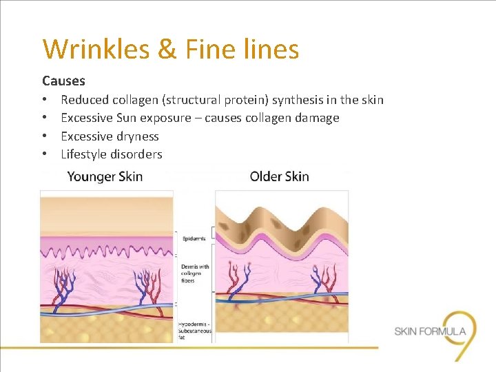 Wrinkles & Fine lines Causes • • Reduced collagen (structural protein) synthesis in the