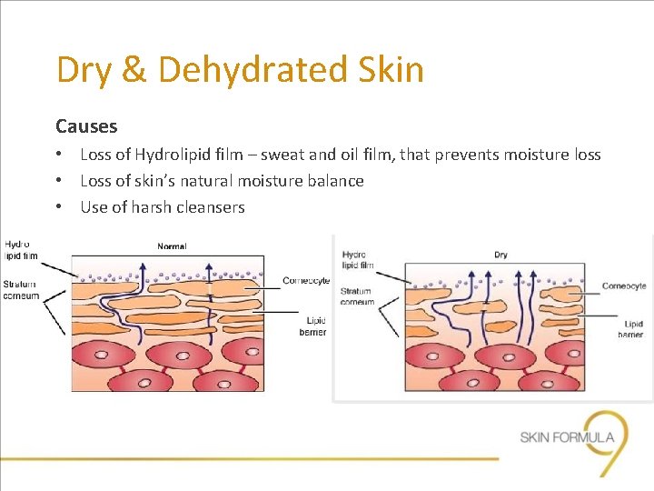 Dry & Dehydrated Skin Causes • Loss of Hydrolipid film – sweat and oil