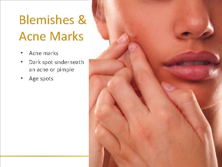 Blemishes & Acne Marks • Acne marks • Dark spot underneath an acne or