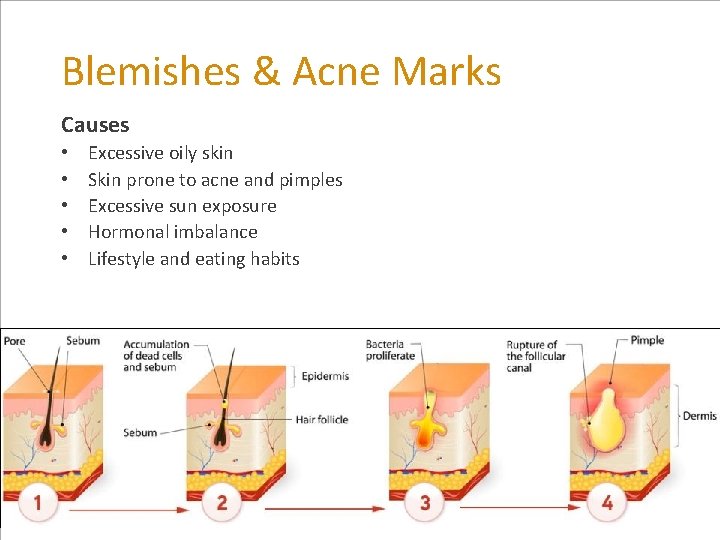 Blemishes & Acne Marks Causes • • • Excessive oily skin Skin prone to