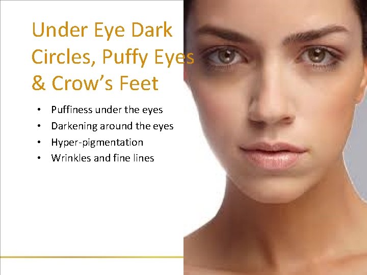 Under Eye Dark Circles, Puffy Eyes & Crow’s Feet • • Puffiness under the