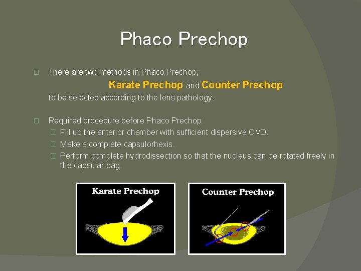 Phaco Prechop � There are two methods in Phaco Prechop; Karate Prechop and Counter