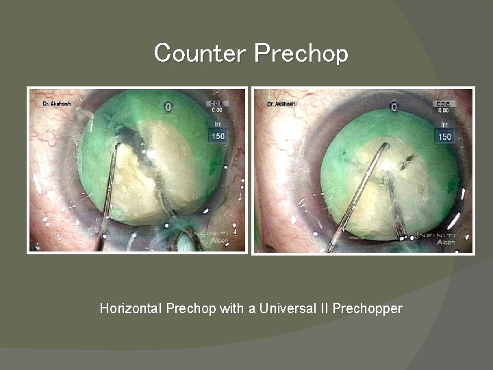 Counter Prechop Horizontal Prechop with a Universal II Prechopper 