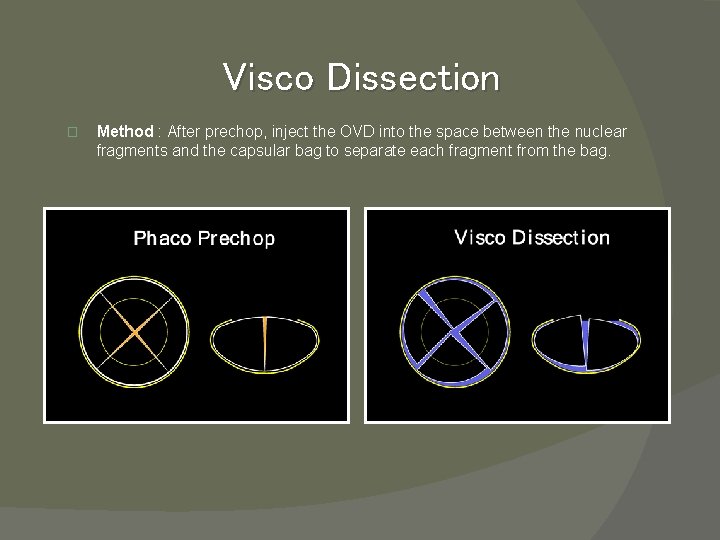 Visco Dissection � Method : After prechop, inject the OVD into the space between
