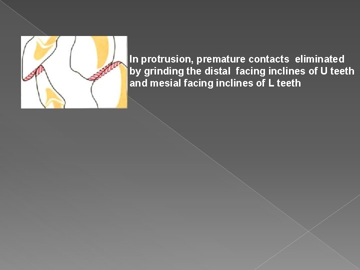 In protrusion, premature contacts eliminated by grinding the distal facing inclines of U teeth