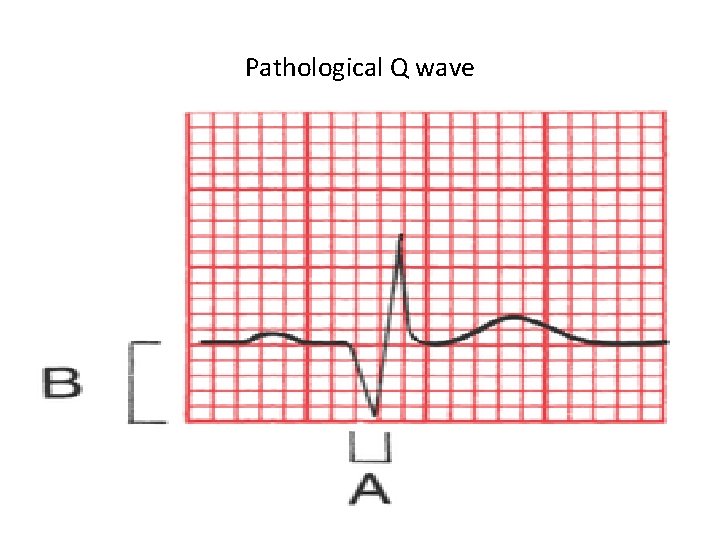 Path Q Wave Cardiac enzymes 2 Non enzyme proteins The Troponins