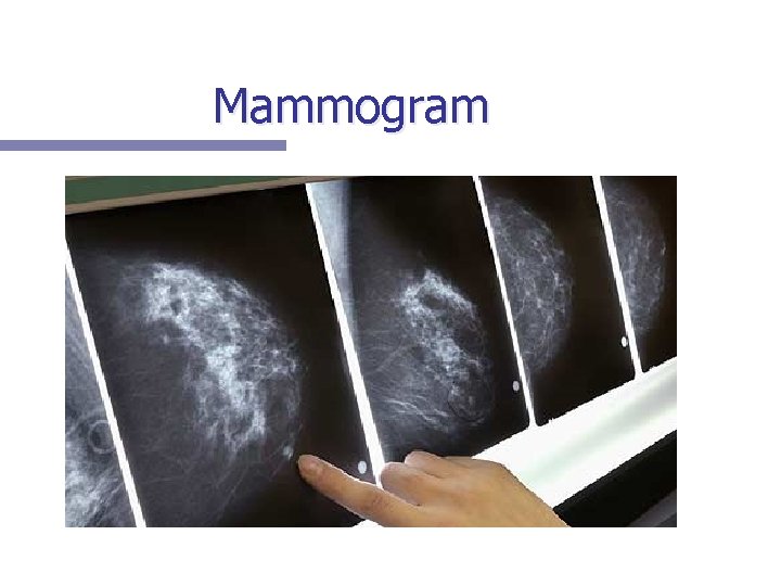 Mammogram 