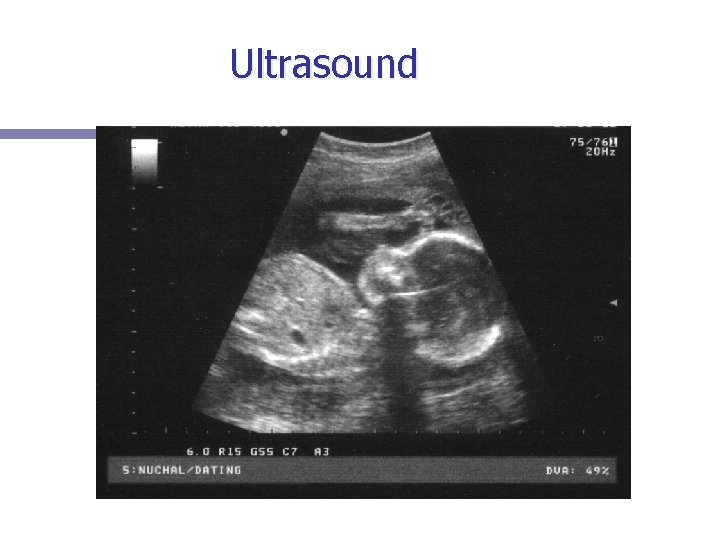 Ultrasound 