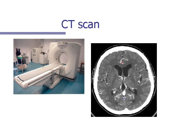CT scan 