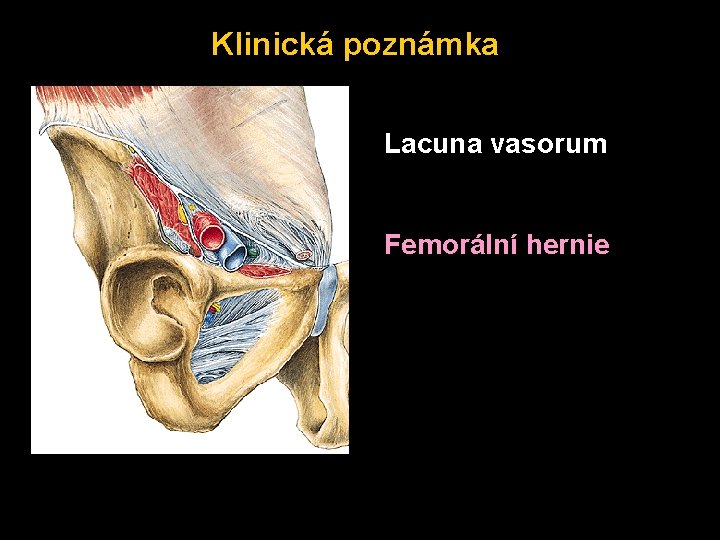 Klinická poznámka Lacuna vasorum Femorální hernie 