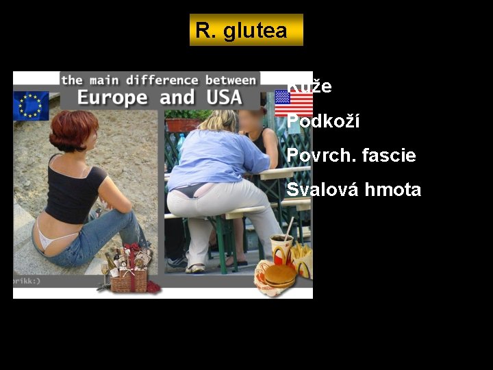 R. glutea Kůže Podkoží Povrch. fascie Svalová hmota 