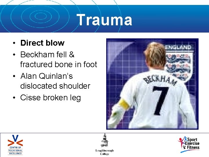 Trauma • Direct blow • Beckham fell & fractured bone in foot • Alan
