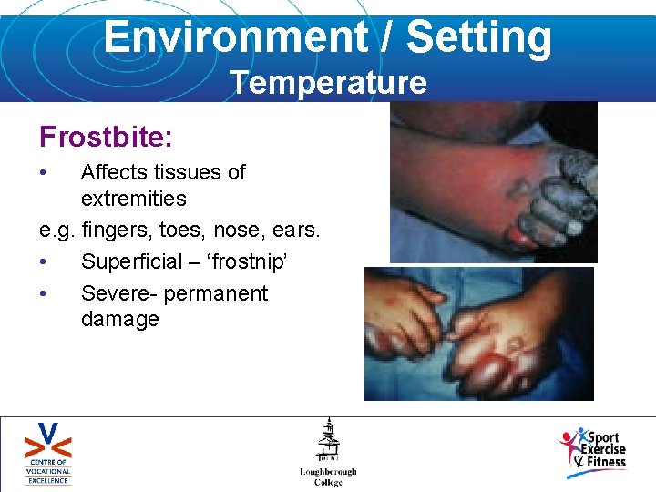 Environment / Setting Temperature Frostbite: • Affects tissues of extremities e. g. fingers, toes,