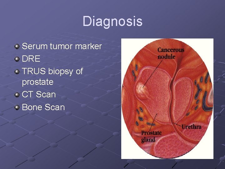 Diagnosis Serum tumor marker DRE TRUS biopsy of prostate CT Scan Bone Scan 
