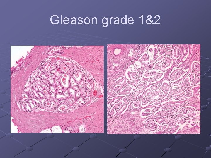 Gleason grade 1&2 