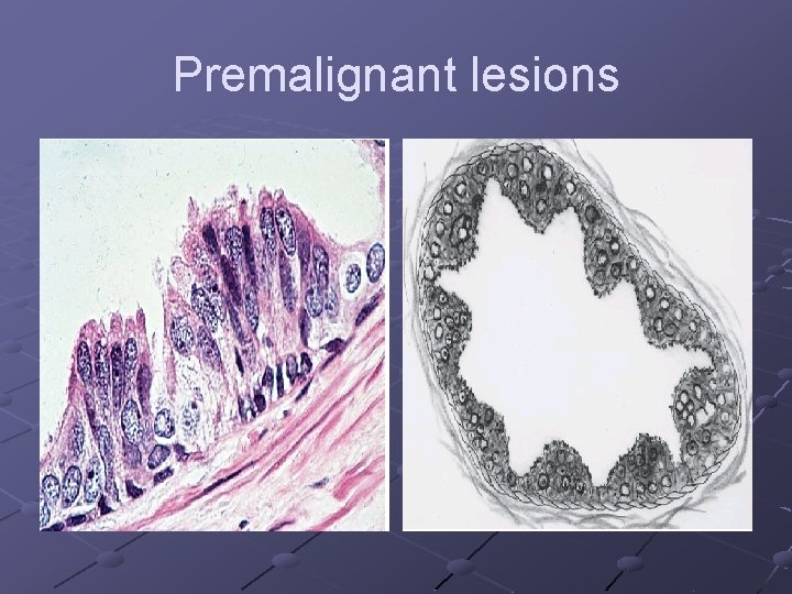 Premalignant lesions 