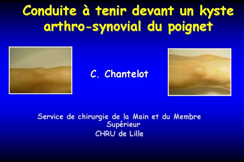 Conduite à tenir devant un kyste arthro-synovial du poignet C. Chantelot Service de chirurgie