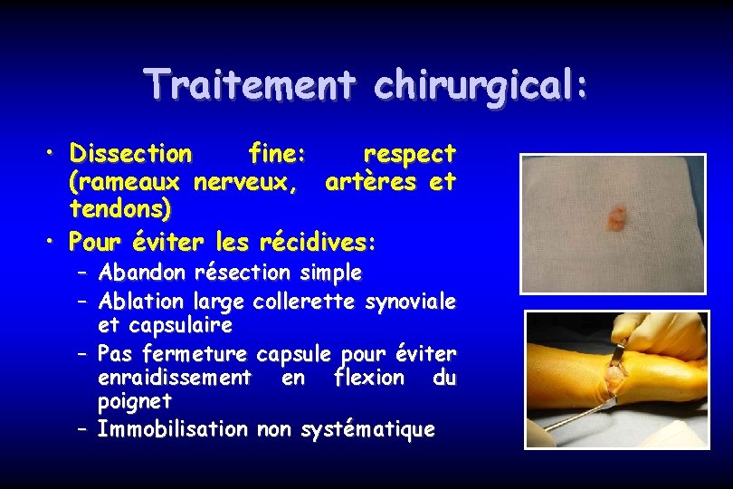 Traitement chirurgical: • Dissection fine: respect (rameaux nerveux, artères et tendons) • Pour éviter