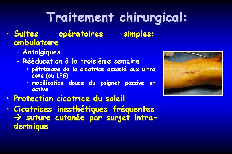 Traitement chirurgical: • Suites opératoires ambulatoire simples: – Antalgiques – Rééducation à la troisième