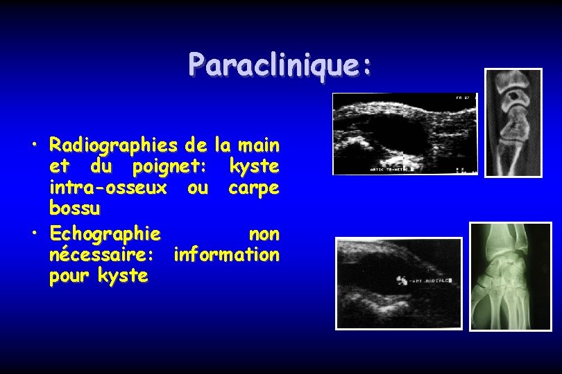 Paraclinique: • Radiographies de la main et du poignet: kyste intra-osseux ou carpe bossu