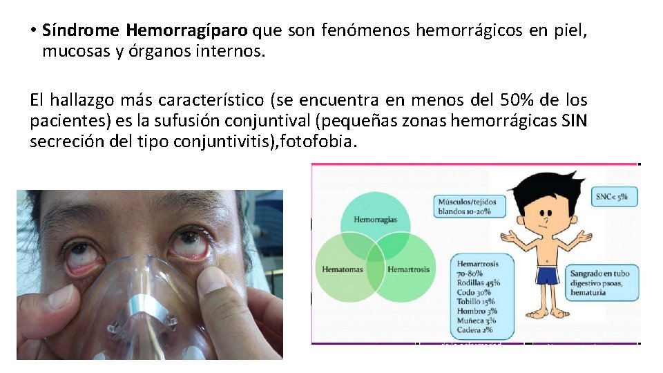  • Síndrome Hemorragíparo que son fenómenos hemorrágicos en piel, mucosas y órganos internos.