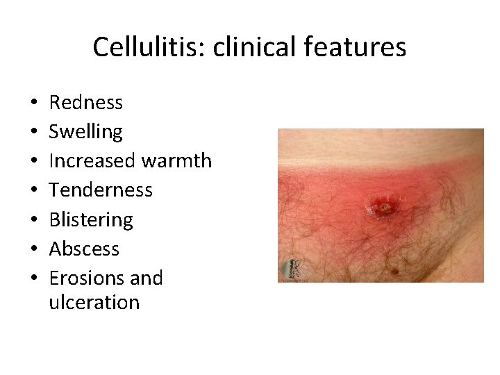 Cellulitis: clinical features • • Redness Swelling Increased warmth Tenderness Blistering Abscess Erosions and Cellulitis: clinical features • • Redness Swelling Increased warmth Tenderness Blistering Abscess Erosions and