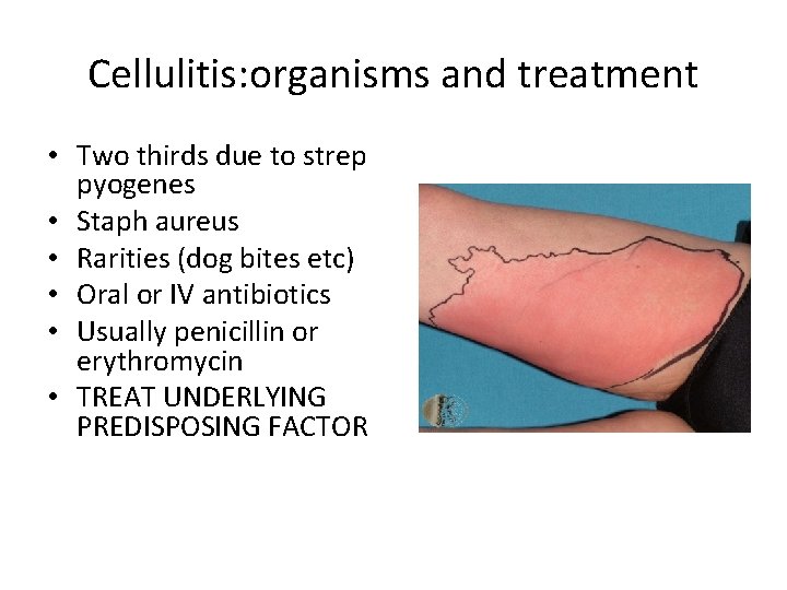 Cellulitis: organisms and treatment • Two thirds due to strep pyogenes • Staph aureus Cellulitis: organisms and treatment • Two thirds due to strep pyogenes • Staph aureus