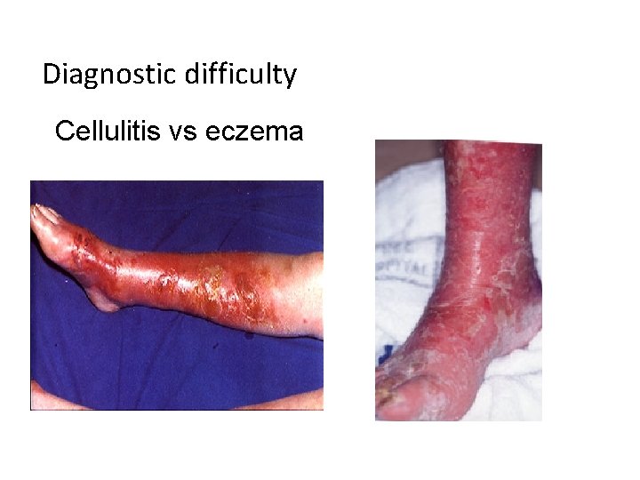 Diagnostic difficulty Cellulitis vs eczema Diagnostic difficulty Cellulitis vs eczema