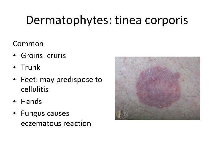 Dermatophytes: tinea corporis Common • Groins: cruris • Trunk • Feet: may predispose to Dermatophytes: tinea corporis Common • Groins: cruris • Trunk • Feet: may predispose to