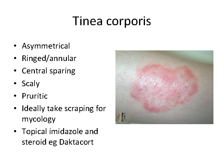 Tinea corporis Asymmetrical Ringed/annular Central sparing Scaly Pruritic Ideally take scraping for mycology • Tinea corporis Asymmetrical Ringed/annular Central sparing Scaly Pruritic Ideally take scraping for mycology •