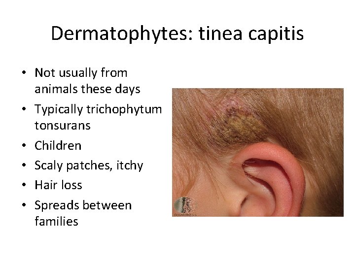 Dermatophytes: tinea capitis • Not usually from animals these days • Typically trichophytum tonsurans Dermatophytes: tinea capitis • Not usually from animals these days • Typically trichophytum tonsurans