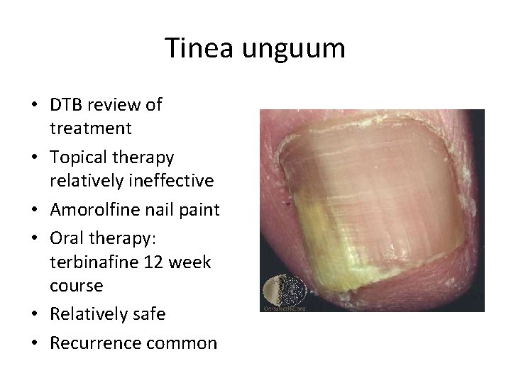 Tinea unguum • DTB review of treatment • Topical therapy relatively ineffective • Amorolfine Tinea unguum • DTB review of treatment • Topical therapy relatively ineffective • Amorolfine