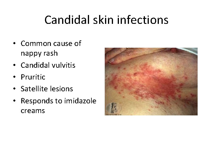 Candidal skin infections • Common cause of nappy rash • Candidal vulvitis • Pruritic Candidal skin infections • Common cause of nappy rash • Candidal vulvitis • Pruritic