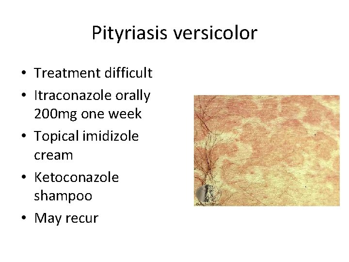 Pityriasis versicolor • Treatment difficult • Itraconazole orally 200 mg one week • Topical Pityriasis versicolor • Treatment difficult • Itraconazole orally 200 mg one week • Topical