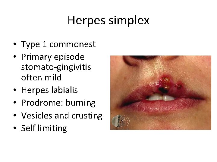 Herpes simplex • Type 1 commonest • Primary episode stomato-gingivitis often mild • Herpes Herpes simplex • Type 1 commonest • Primary episode stomato-gingivitis often mild • Herpes