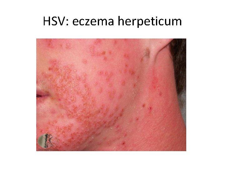 HSV: eczema herpeticum HSV: eczema herpeticum