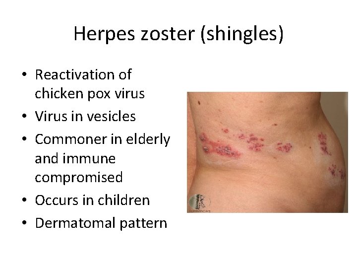 Herpes zoster (shingles) • Reactivation of chicken pox virus • Virus in vesicles • Herpes zoster (shingles) • Reactivation of chicken pox virus • Virus in vesicles •