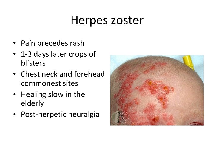 Herpes zoster • Pain precedes rash • 1 -3 days later crops of blisters Herpes zoster • Pain precedes rash • 1 -3 days later crops of blisters