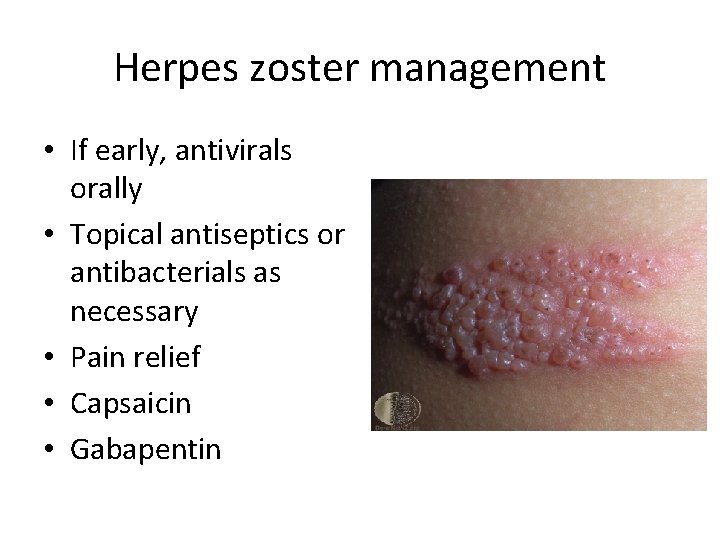 Herpes zoster management • If early, antivirals orally • Topical antiseptics or antibacterials as Herpes zoster management • If early, antivirals orally • Topical antiseptics or antibacterials as
