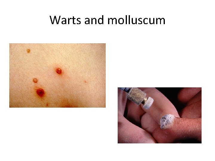 Warts and molluscum Warts and molluscum