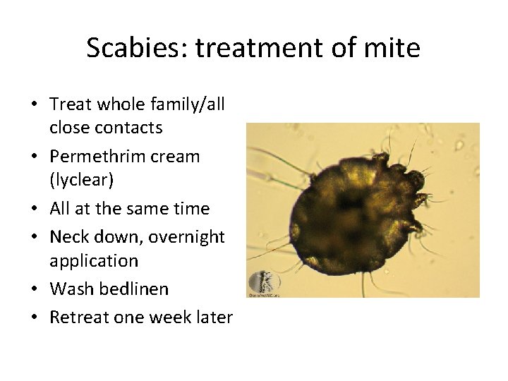 Scabies: treatment of mite • Treat whole family/all close contacts • Permethrim cream (lyclear) Scabies: treatment of mite • Treat whole family/all close contacts • Permethrim cream (lyclear)