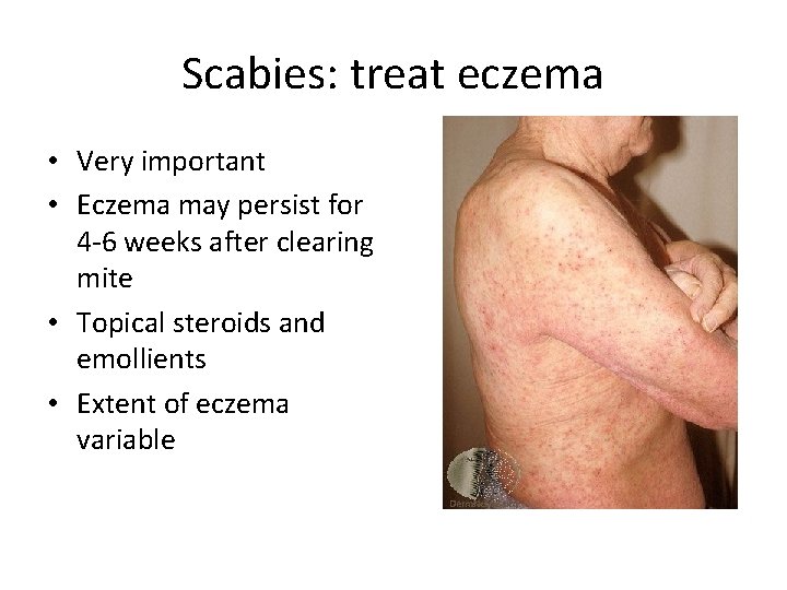 Scabies: treat eczema • Very important • Eczema may persist for 4 -6 weeks Scabies: treat eczema • Very important • Eczema may persist for 4 -6 weeks