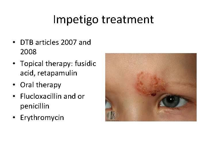 Impetigo treatment • DTB articles 2007 and 2008 • Topical therapy: fusidic acid, retapamulin Impetigo treatment • DTB articles 2007 and 2008 • Topical therapy: fusidic acid, retapamulin
