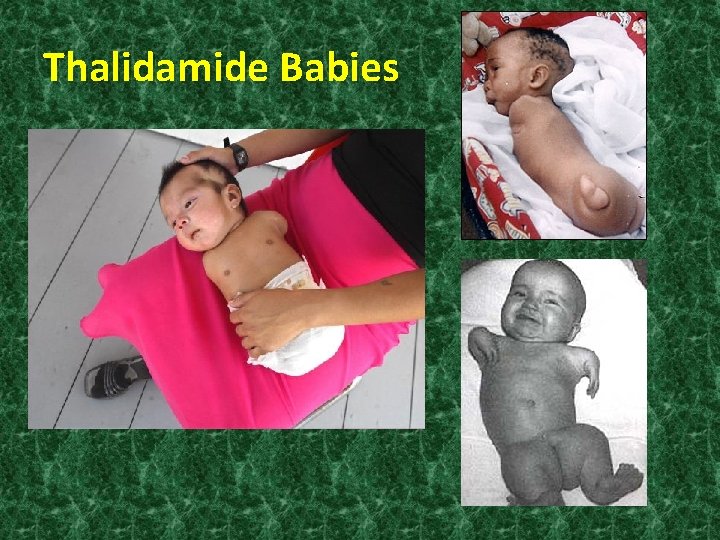 Thalidamide Babies 