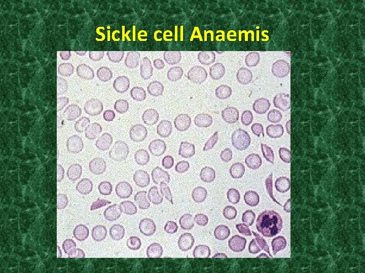 Sickle cell Anaemis 