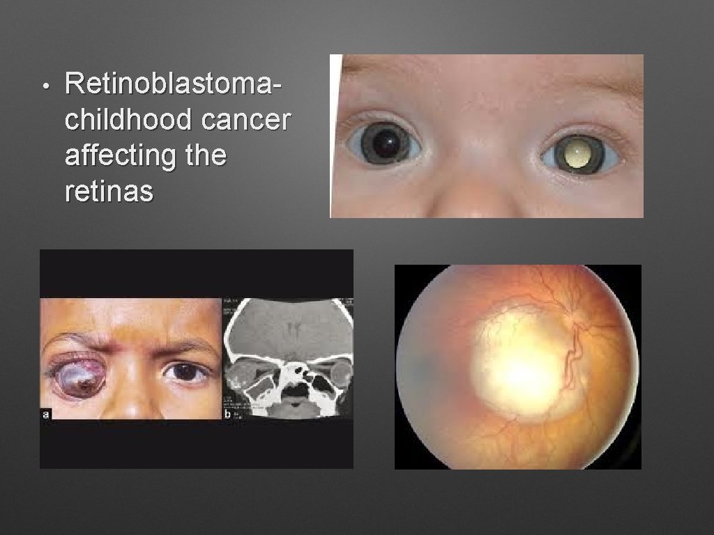  • Retinoblastoma- childhood cancer affecting the retinas 