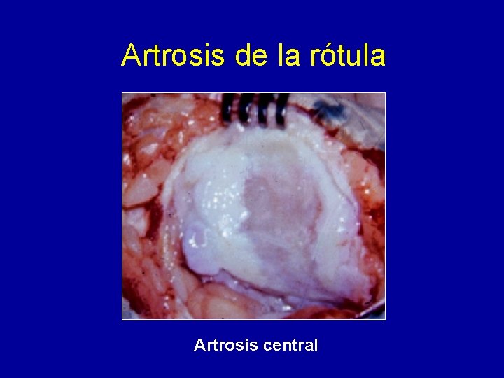 Artrosis de la rótula Artrosis central 