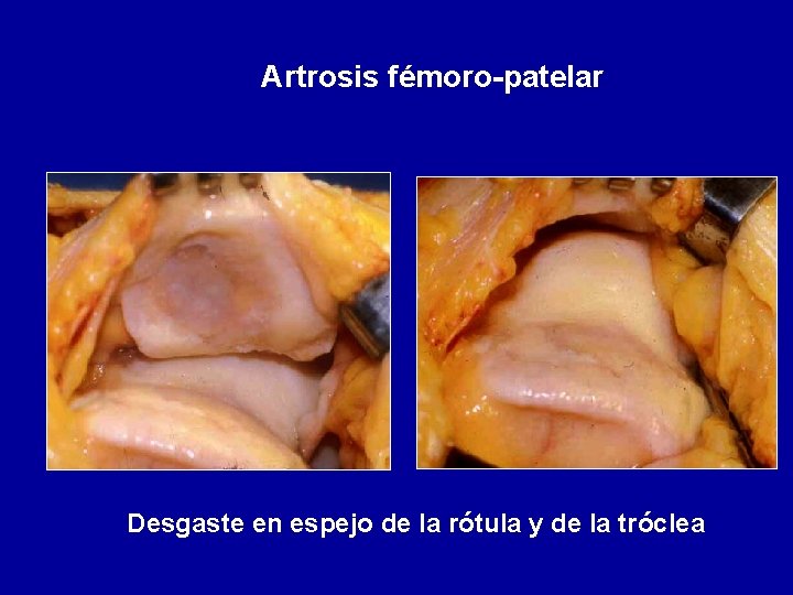 Artrosis fémoro-patelar Desgaste en espejo de la rótula y de la tróclea 