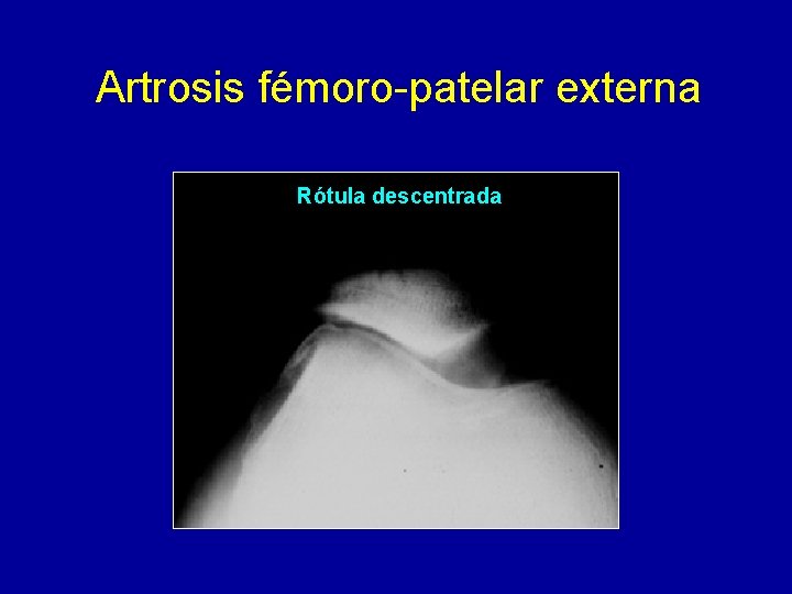 Artrosis fémoro-patelar externa Rótula descentrada 